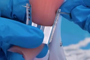 运动员们的跟腱都是怎么修复的？这么看起来真的太辛苦了